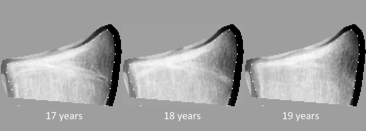 Automated bone age extended up to 19 years